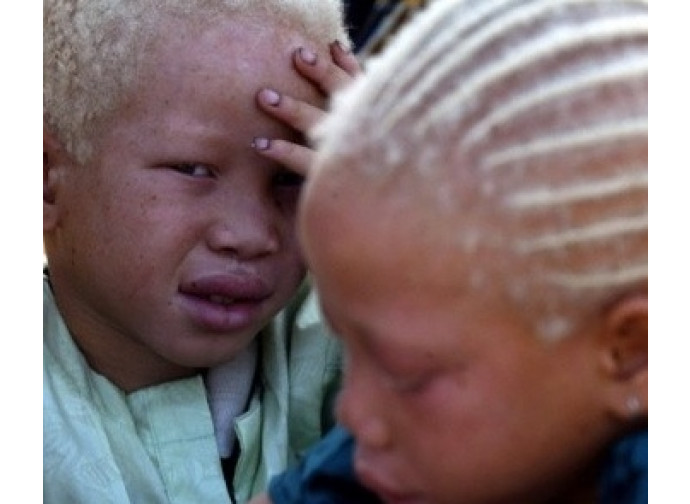 Bambini albini