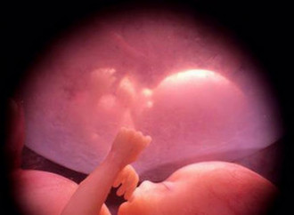 L’aborto e la strategia radicale dell’Oms