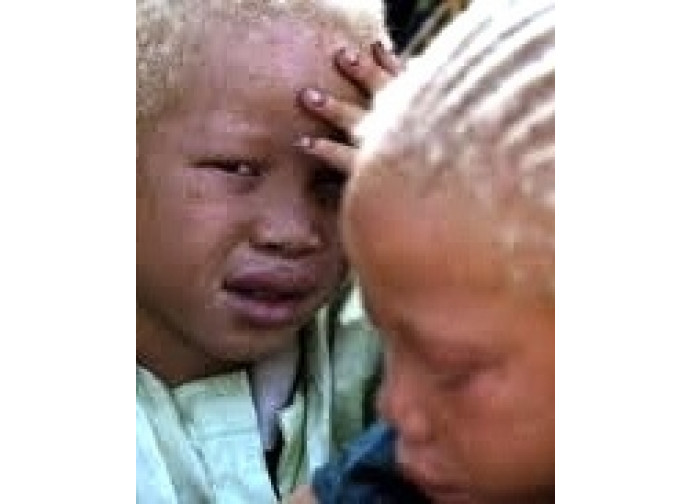 Bambini africani albini Bambini africani albini